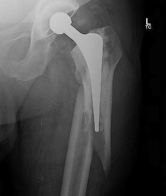 THR Periprosthetic Fracture B1